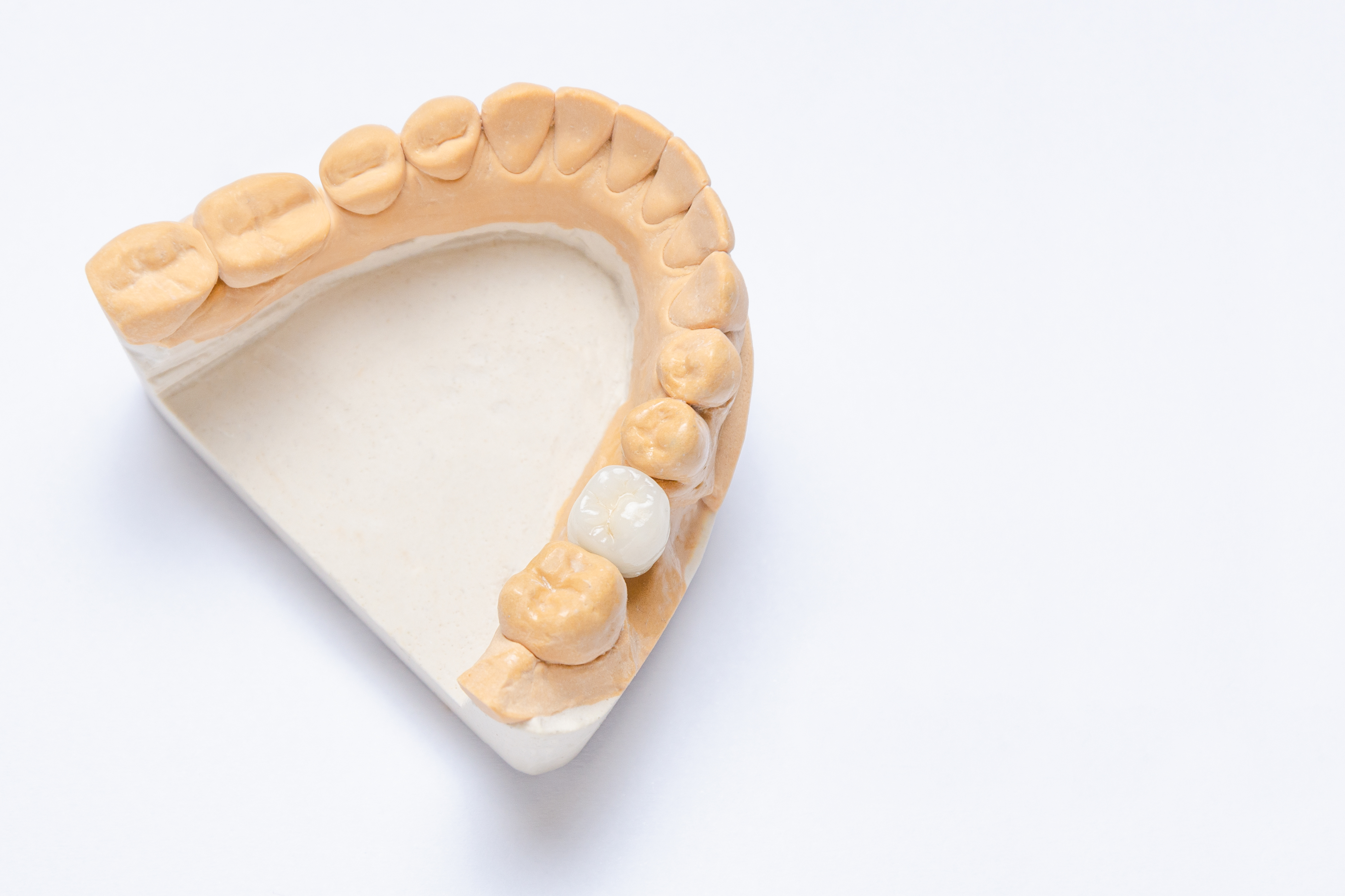 on a white background is a plaster model of the lower jaw with a ceramic crown made on a dental implant. dental prosthetics concept. crown making